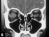 Figure 6: CT scan after biopsy