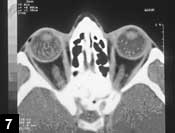 Figure 7: CT scan after biopsy