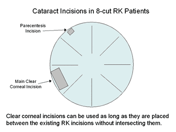 Cataract incisions in 8-cut RK patients