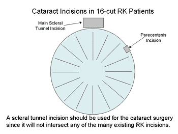 Cataract incisions in 16-cut RK patients