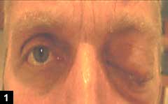 Figure 1: Complete ptosis and mild periorbital tissue swelling of left eye