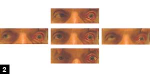 Figure 2: Full extraocular movement of right eye and complete ophthalmoplegia in left eye