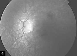 Figure 4: Fluorescein angiogram of left eye