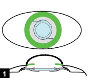 Figure 1: The IOL optic and haptics are placed in capsular bag