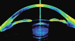 Time-domain OCT image of the anterior segment of the eye