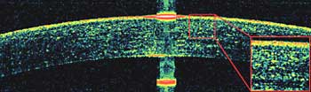 A Fourier-domain (FD-OCT) image of the cornea with the tear film