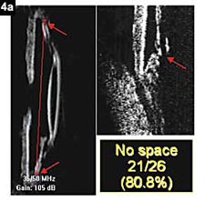 Figure 4a: Postoperative distance between ciliary ring and equator of the bag was virtual in more than 80% of eyes