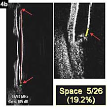 Figure 4b:  In 19.2% of eyes only some space between the equator and the ciliary ring was noted