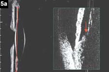 Figure 5a: If the capsular bag plane is posterior to the ciliary apex, there is no possibility of anterior movement