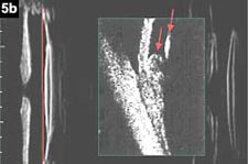 Figure 5b: If the capsular bag plane is posterior to the ciliary apex, there is no possibility of anterior movement