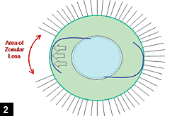 Figure 2: IOL placed in the capsular bag