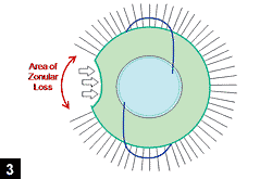 Figure 3: IOL placed in the ciliary sulcus