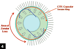 Figure 4: IOL placed in the capsular bag