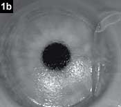 Figure 1b: Iris image taken with STAAR supine