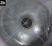 Figure 2b: LVC treatment (photopic)