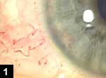 Figure 1: Dilated and tortuous conjunctival and episcleral vessels in a corkscrew pattern