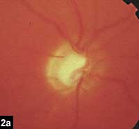 Figure 2a: Enlargement of right optic cup with pallor and thinning of the inferotemporal rim