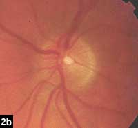 Figure 2b: Healthy appearing left optic nerve