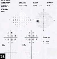 Figure 3a: Superior arcuate, superior and inferior nasal steps, and paracentral scotoma