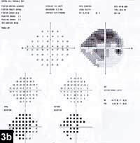 Figure 3b: No field defects