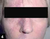 Figure 4: External photograph showing nevus flammeus