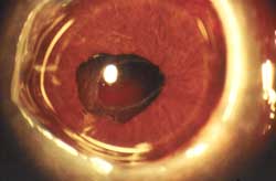 Patient with no cornea on the eye