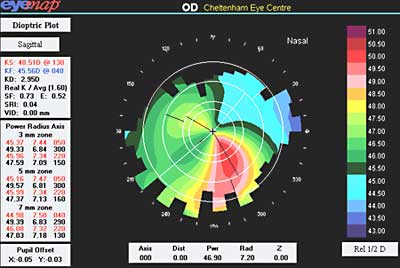 Eyemap showing topical keratoconic profile