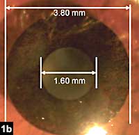 Figure 1b: The AcuFocus corneal inlay gets centered over the pupil