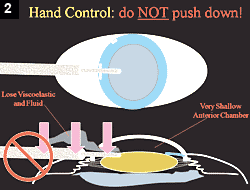 Figure 2: Hand Control: do NOT push down!