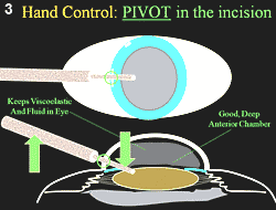 Figure 3: Hand Control: PIVOT in the incision