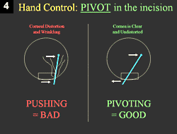 Figure 4: Hand Control: PIVOT in the incision