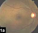 Figure 1a: Drusen and retinal pigment epithelium pigmentary changes