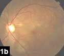 Figure 1b: Multiple yellow perivascular infiltrative choroidal lesions