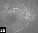 Figure 2a: Punctate areas of mild hyperfluorescence in the late frames