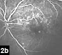 Figure 2b: Multiple pinpoint areas of hyperfluorescence