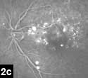 Figure 2c: Multiple pinpoint areas of hyperfluorescence