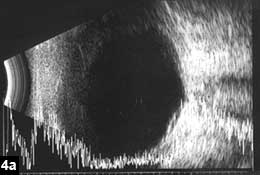 Figure 4a:  Thickening of the posterior choroid