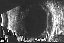 Figure 4b: Peripheral choroidal detachments