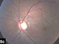 Figure 5c: Infiltrative lesions and choroidal detachments