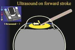 Ultrasound on forward stroke