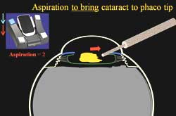 Aspiration to bring cataract to phaco tip