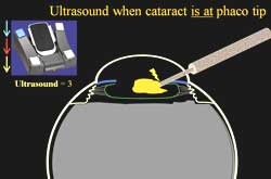 Ultrasound when cataract is at phaco tip