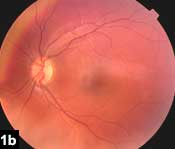 Figure 1b: Color fundus photograph