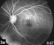 Figure 3a: Oral fluorescein angiogram of the left eye