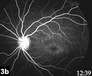 Figure 3b: Oral fluorescein angiogram of the left eye