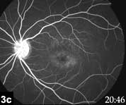 Figure 3c: Oral fluorescein angiogram of the left eye