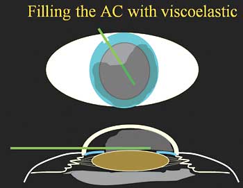 Filling the AC with viscoeleastic