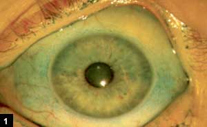 Figure 1: 47-year-old patient with contact lens intolerance, giant papillary conjunctivitis, a history of asthma and is using oral antihistamines