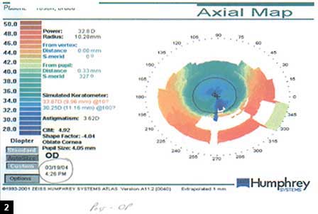 Figure 2: Topography of same patient 6 months after LASIK