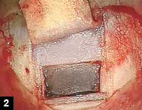 Figure 2: Dissection of deep scleral flap